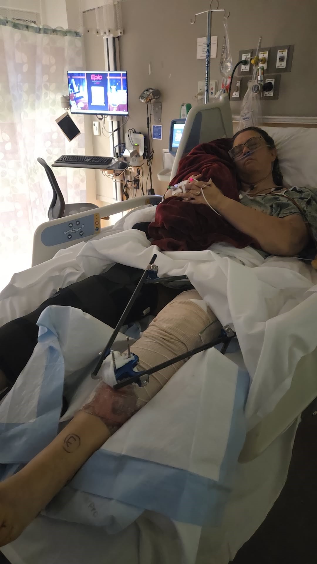Joan Cortez recovering in the hospital following the motorcycle accident. 